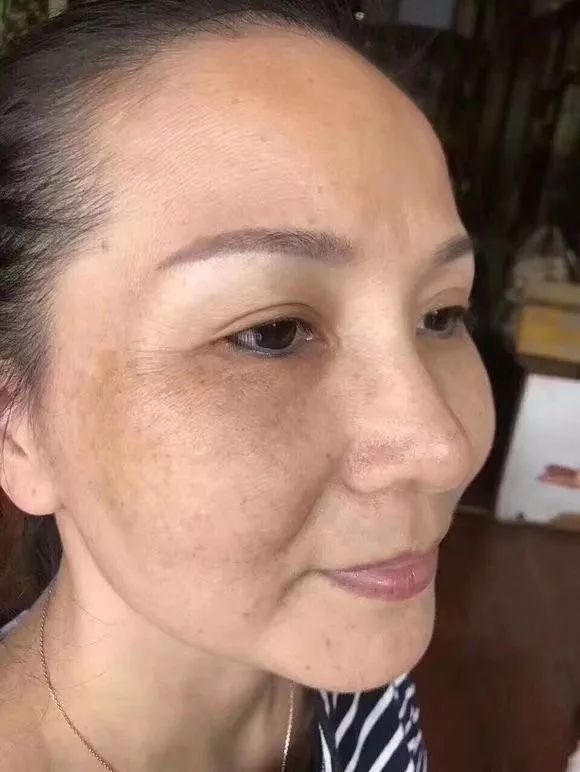 面部斑点_去面部斑点