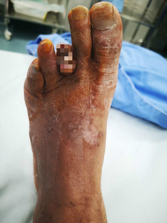 每20秒全球就有一例糖尿病患者截肢