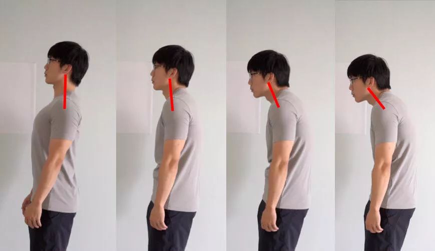 当含胸驼背成为女友和我分手的理由