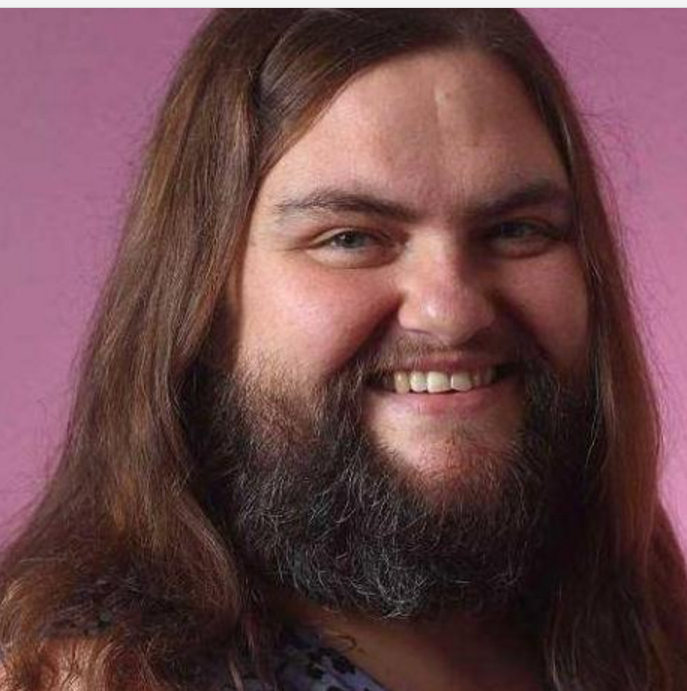 美国一女子满脸胡子体毛旺盛,医生也没办法,如今成这样!