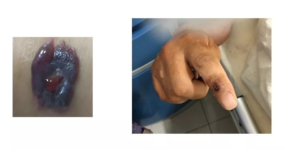 市中心医院感染科成功治愈两例散发皮肤炭疽患者