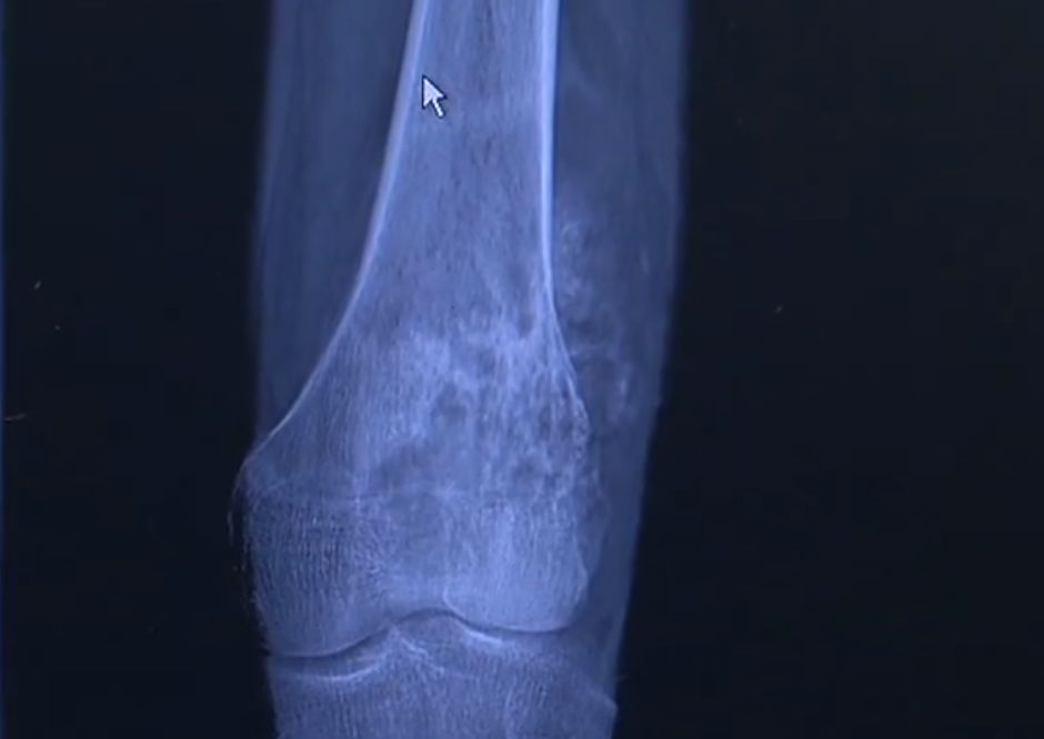 最后被诊断为骨肉瘤(俗称骨癌)结果让小颖父母吓了一跳!