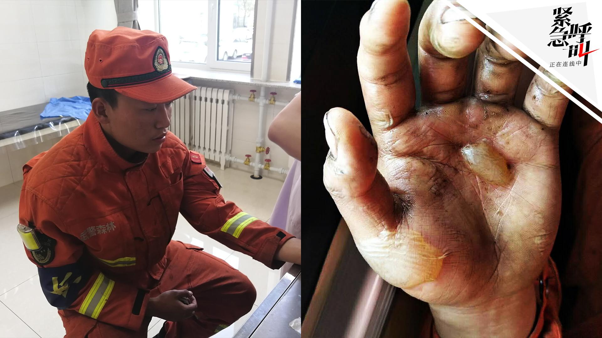 消防战士烧伤的手图片
