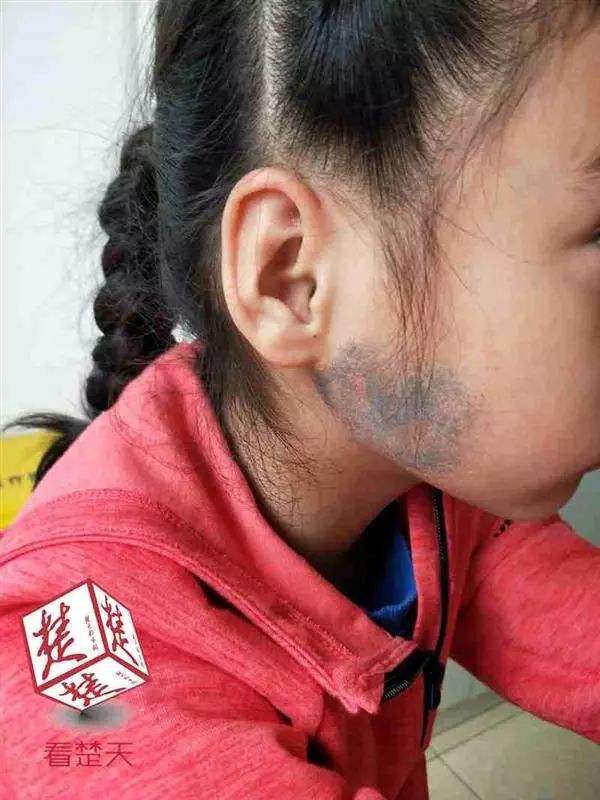 26岁壮小伙患上无精症,竟是因为5年前的这件事|附睾炎|腮腺炎|乔乔