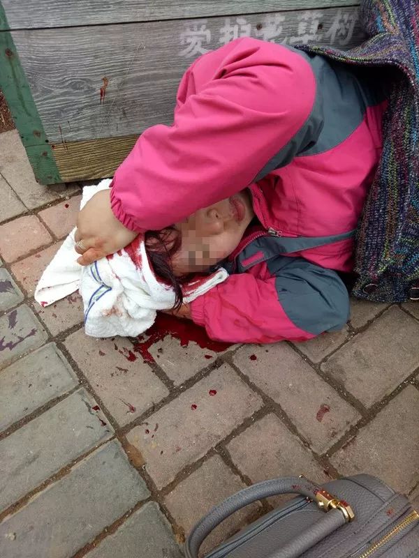 1米长金属框从天而降大连35岁女子脑袋开花缝23针面临毁容