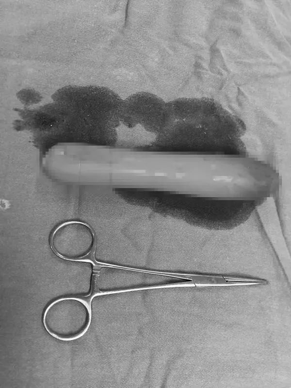 肛门|异物|直肠_新浪新闻