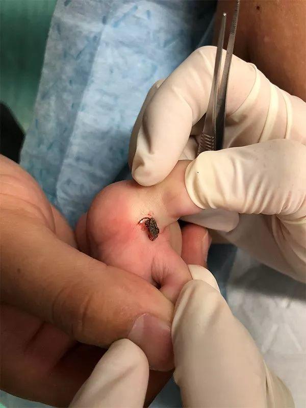 女孩脚趾间多了颗"黑痣"妈妈被吓得尖叫