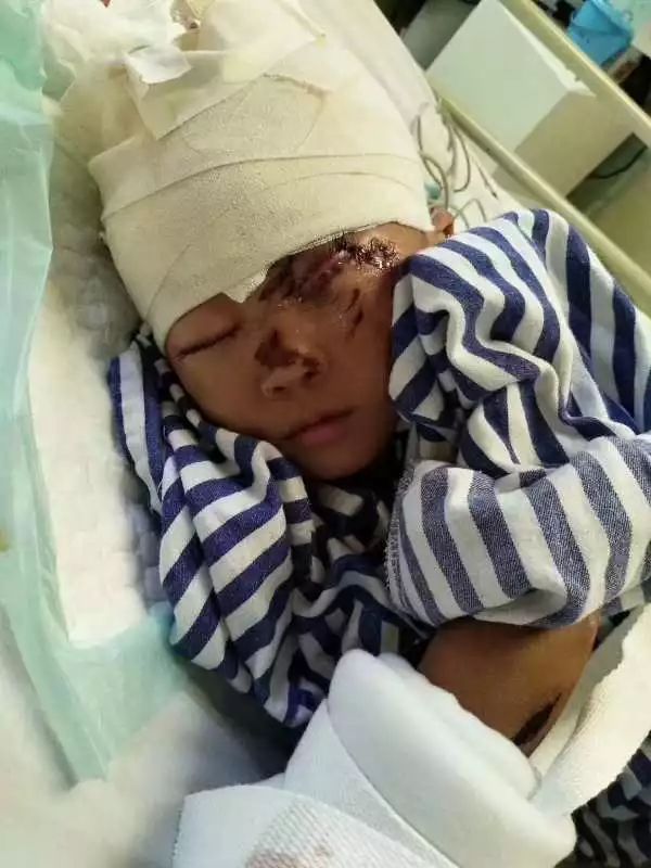 急龙泉未满两岁的男孩遭遇车祸脑壳破了一个洞56岁的养父一筹莫展