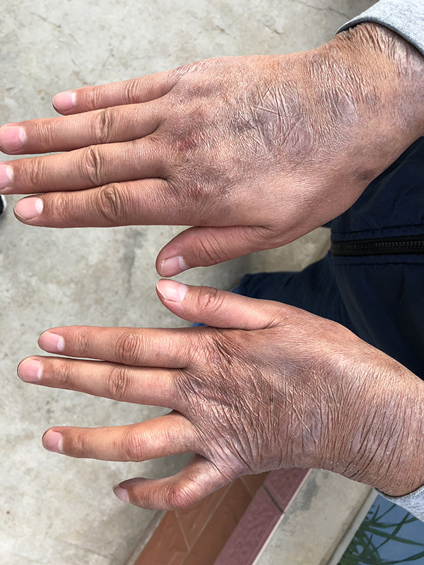 流浪的80后麻风病人:与家人断去联系4年,望做回正常人