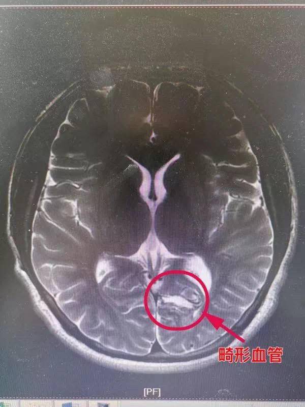 险健身达人跌倒后神志不清南京市中医院成功救治脑血管畸形患者
