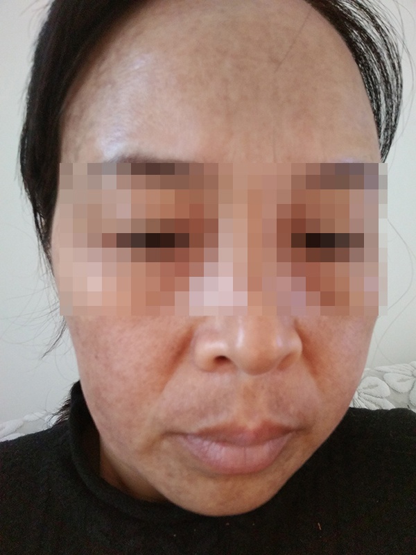 liuyan:女子称祛斑不成反长一脸黑斑 柳岩曾代言该产品 刘女士使用三个月后的皮肤 受访者刘女士供图