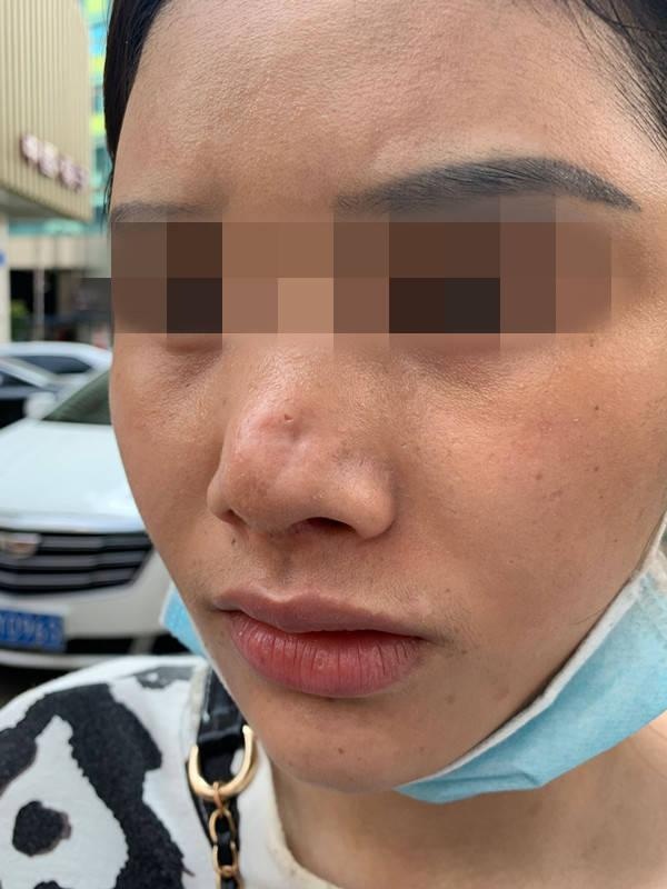 一女子贷款5.5万元修复隆鼻,结果鼻头出现凹陷