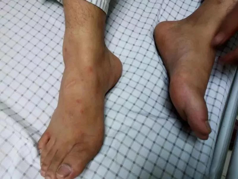 女子被这种虫咬后休克险丧命