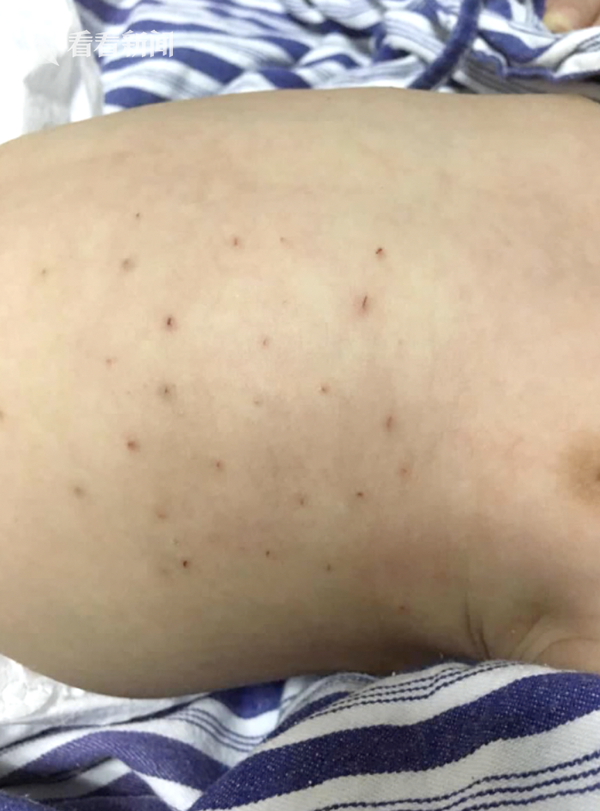 视频父母迷信偏方扎针治闹夜结果把50天男婴送进icu