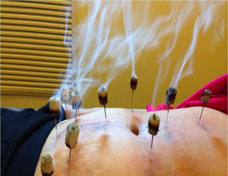 15次温针灸, 子宫肌瘤消失(配有艾灸穴位和方法)