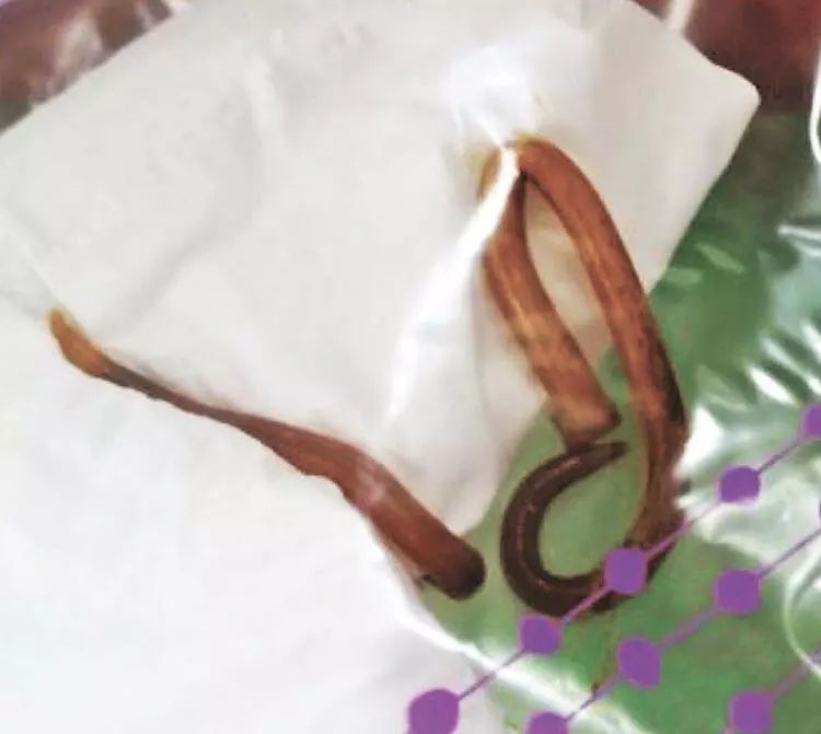 小伙刷牙竟吐出条虫子,就因为经常吃它