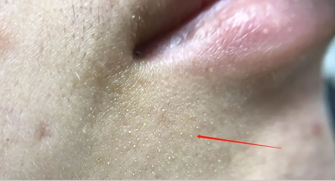 黑头收割机!我的"陈年草莓鼻"居然被他救好了!