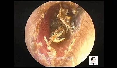 如果长这么大没掏过耳屎会怎么样