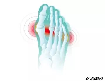 防损伤专栏|前脚掌疼痛,有可能是"跖骨"搞的鬼