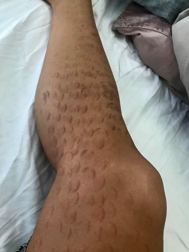 加拿大美女舞者花费近4万元激光脱毛双腿被灼伤布满鱼鳞状疤痕