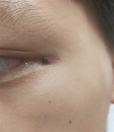 男童眼角多颗"黑痣",竟然是蜱虫!