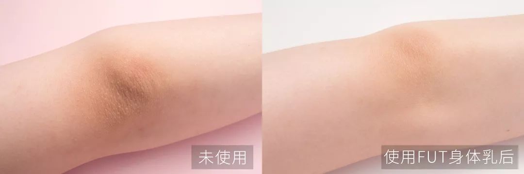 涂身体乳手臂起红痘痘疼(涂了身体乳后手臂上有小疙瘩) 涂身体乳手臂起红痘痘疼(涂了身体乳后手臂上有小疙瘩)