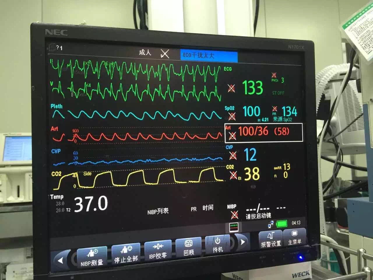 　　2016年2月，王国华“完成取心”任务后，等到受体心脏顺利复跳，才离开手术室。受访者供图