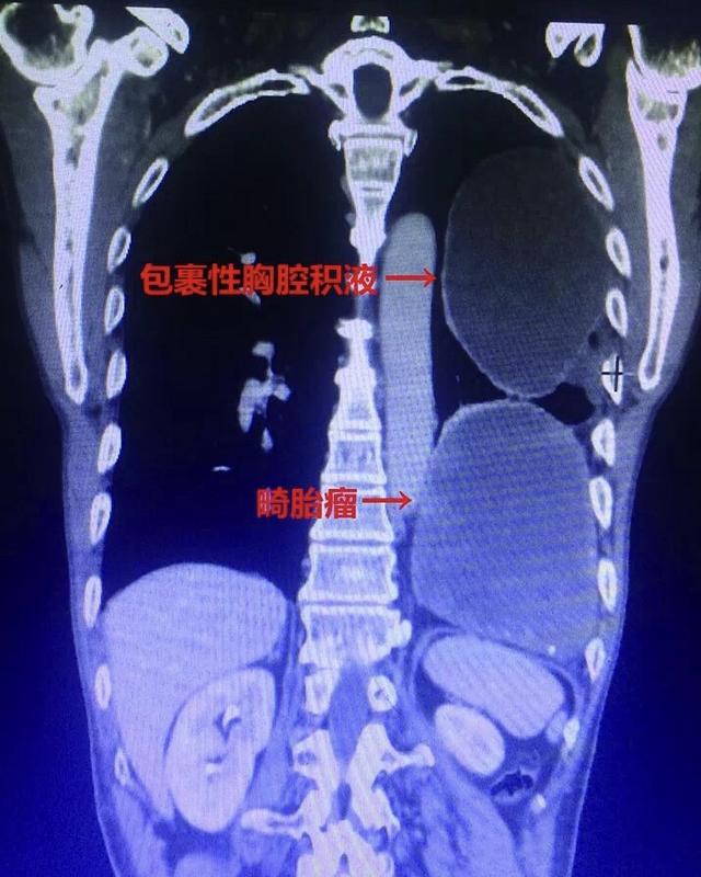 阜康64岁男子感冒咳嗽一直不好 原是胸腔"藏"64年畸胎瘤