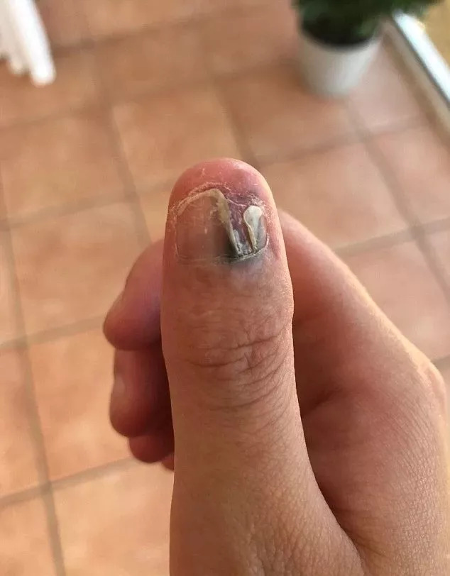 女大学生一紧张就"咬指甲",咬着咬着就麻木了,最后被截肢