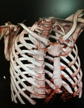 断了8根肋骨,胸骨骨折……就因为多喝了那么几杯