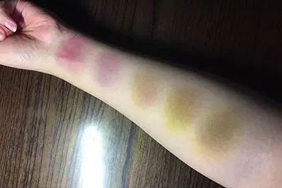 为什么女生的膝盖上经常会有淤青?__财经头条