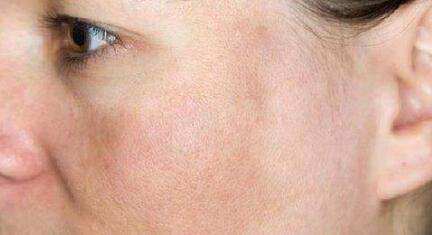 酱油吃多了,皮肤容易发黑?辟谣:黑色素沉淀,跟饮食几乎没关系|饮食|辟