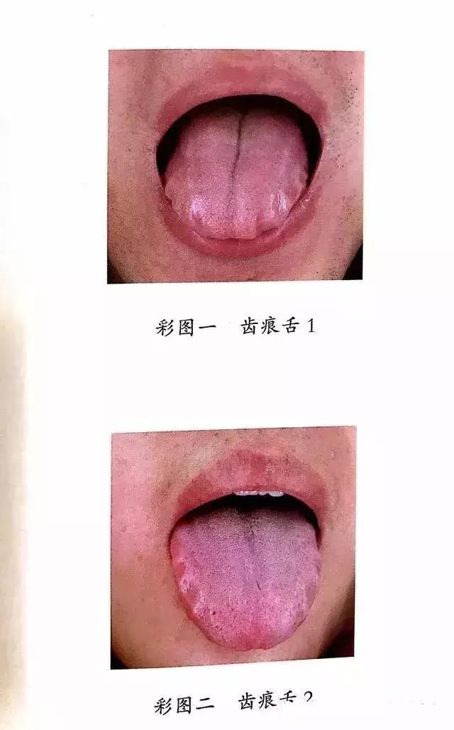 气虚之人,舌有齿痕;气虚、有湿气,吃什么好?