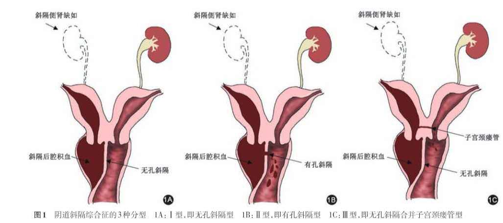 15岁女孩总是痛经竟是因为长了两个子宫