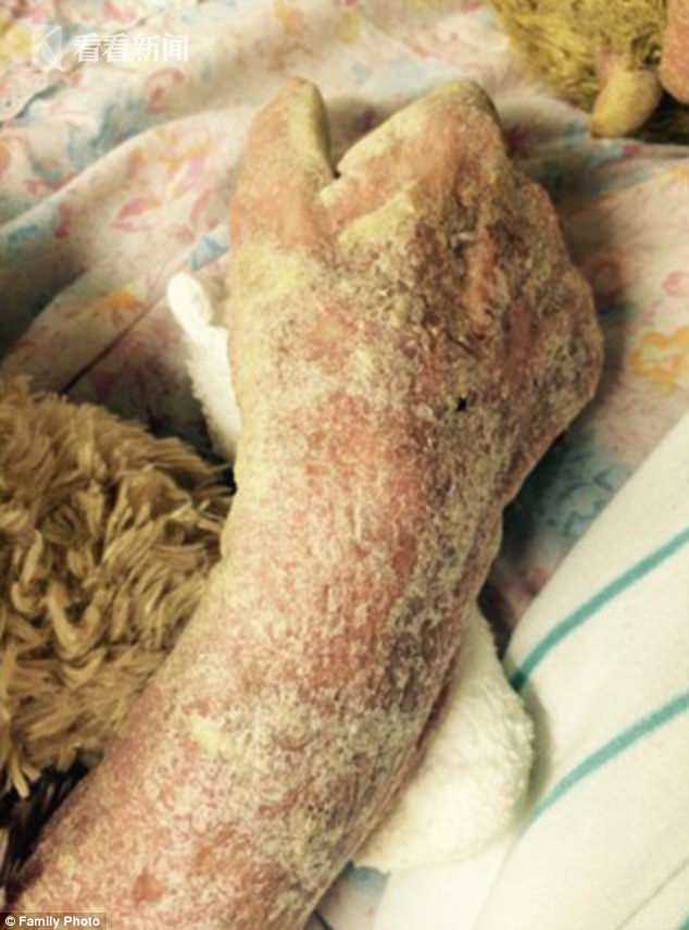 老太满身寄生虫