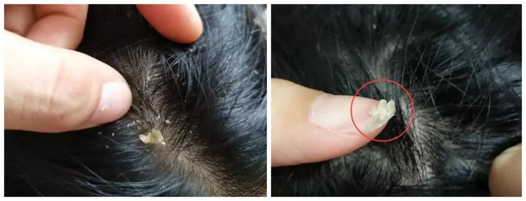 头皮上扣下的白泥是什么怪不得头发都要掉光了