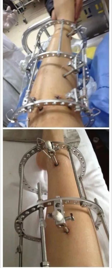 (前方高能预警)之后这个手术就成为了小儿麻痹后遗症,肢体畸形的患者