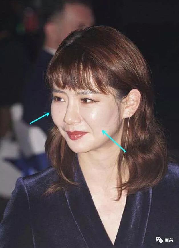 酒窝变酒坑苹果肌炸裂她的脸到底是怎么了