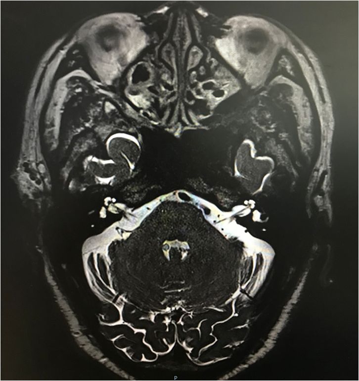 医疗动态得了14年的三叉神经痛彻底解决了
