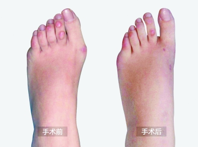 微创无痛治疗拇外翻脚觚拐不缝针无需钢钉内固定恢复快不留后遗症