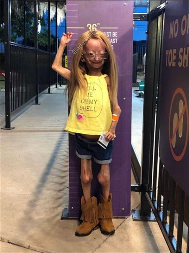 早衰症女孩头发掉光形如et外星人乐观不屈收获150万粉丝