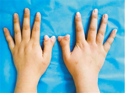 年龄,应该性格开朗,但小美因双手拇指畸形对她造成了严重的自卑心理