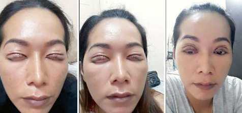 泰国一单眼皮女子割双眼皮失败 双眼皮竟变成"三眼皮"