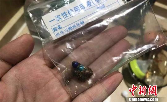从患者体内取出的磁力珠，其中有3颗已经被肠液腐蚀发黑。浙江大学明州医院供图