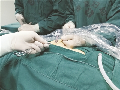 腹部脂肪足有二十厘米厚两百多斤女患者手术过关斩将