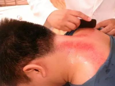 刮痧越疼越黑越有效?很多人都被误导了