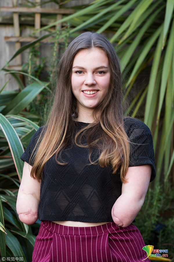 曾经被确诊过存活率只有1%的四肢截肢女孩isabelle weall战胜重重困难