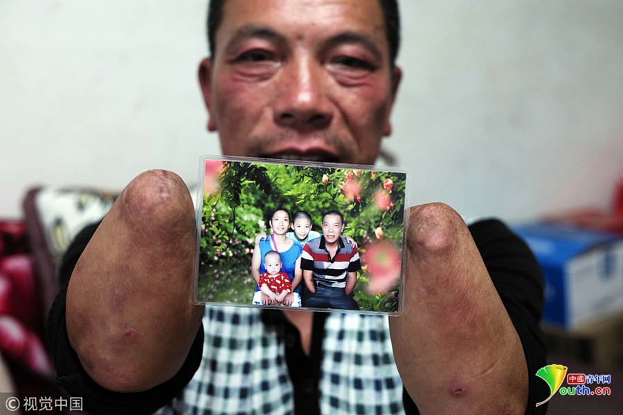 重庆无手硬汉干活抽烟数钱样样行还娶了漂亮老婆