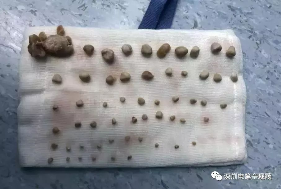 扩散丨9岁娃肾里取出56颗结石!很多小孩都有这样的饮食习惯!