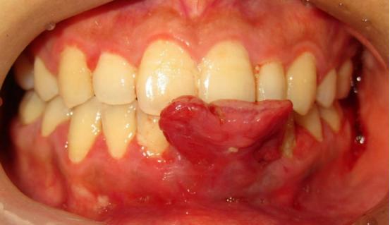 牙龈长红色肉疙瘩图图片